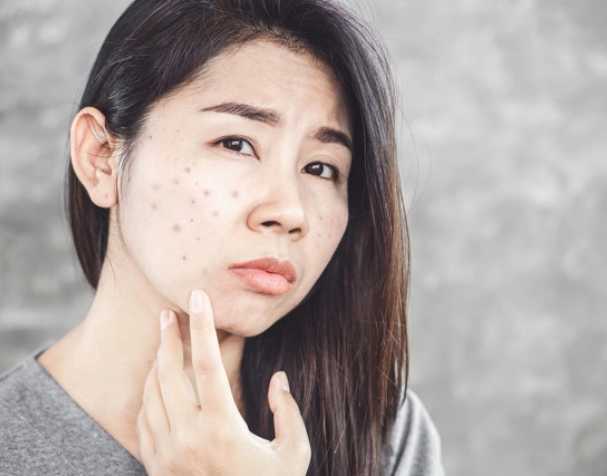 古特生物 谷胱甘肽与痤疮严峻水平的相干性